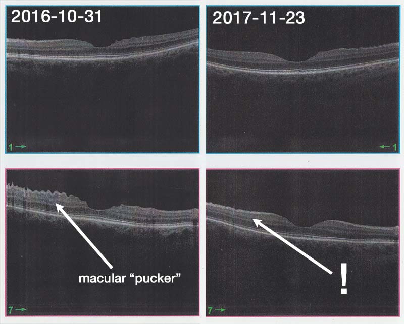 macular "pucker" improvement in a year