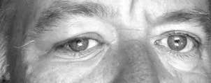 Eyes after bee attack