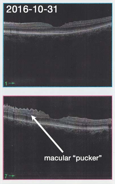 macular "pucker"